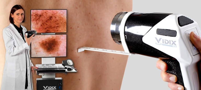 Videodermatoscopia (Mappatura dei nei)